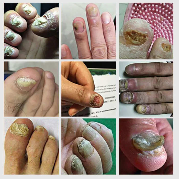 Fungal Nail Laser Device