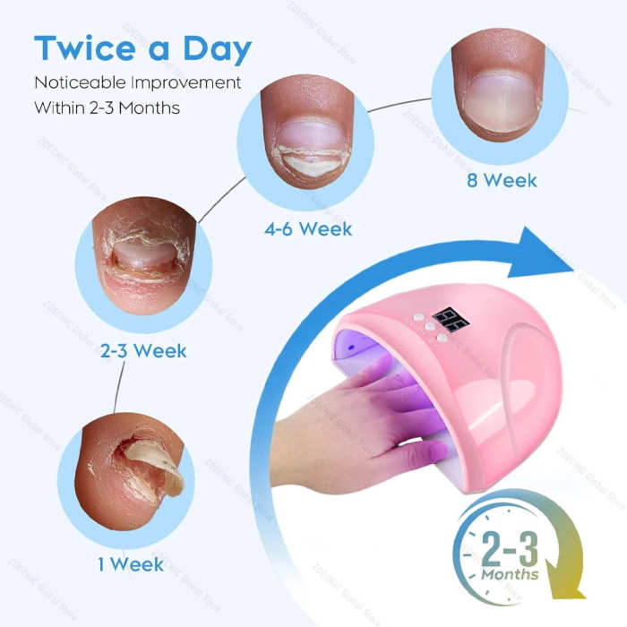 Fungal Nail Laser Device