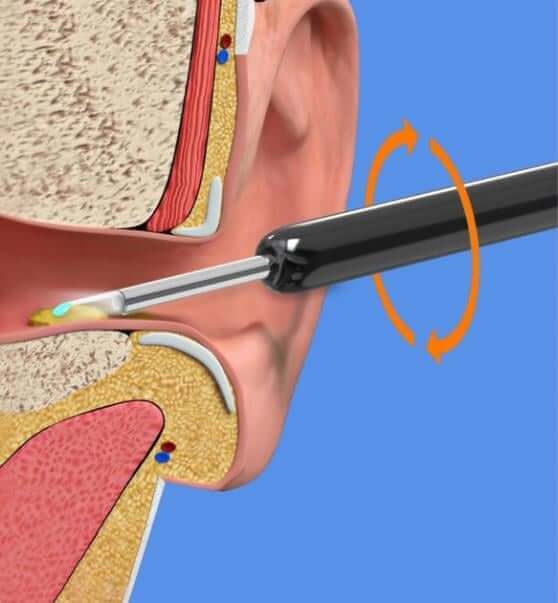 Ear Cleaner with Built-in Hd Camera as that used by doctors