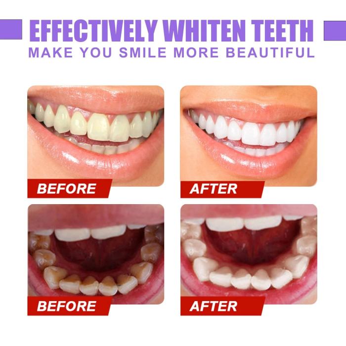 Hot Sale-49% OFFTeeth Colour Corrector Serum