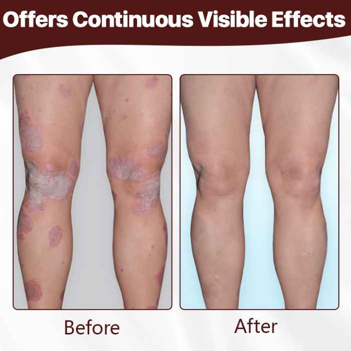 Biancat Cow's Fart Eczema Essence