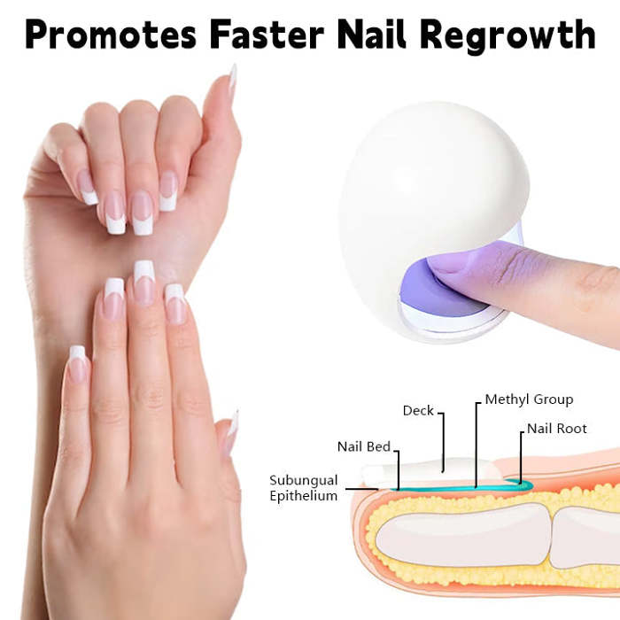 BiancatNailFungusLaserCleaningRepairDevice