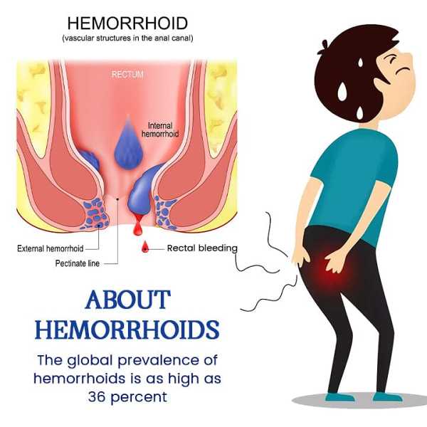 Biancat AnalEase Hemorrhoid Repair Herbal Capsules