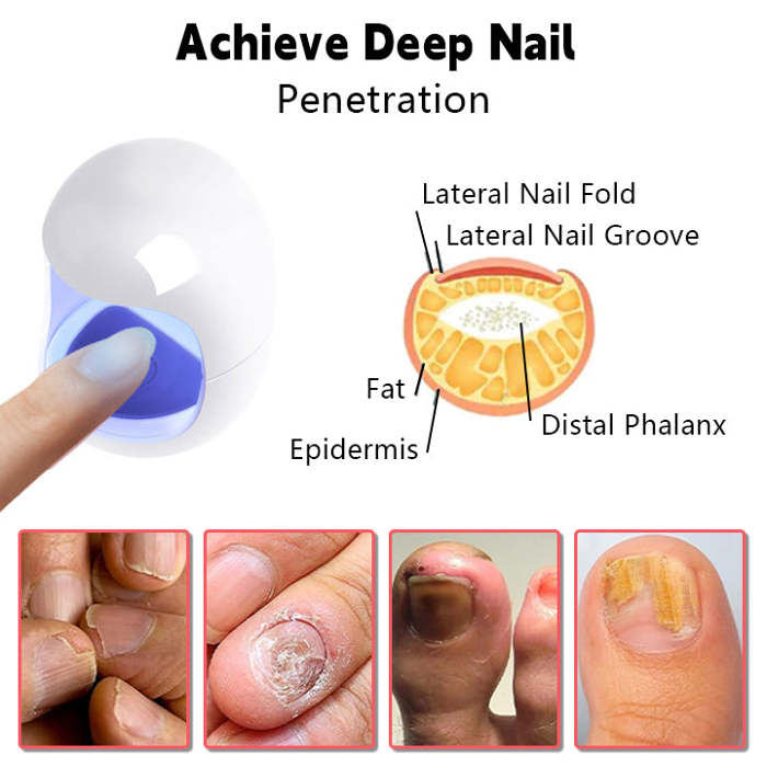 BiancatNailFungusLaserCleaningRepairDevice