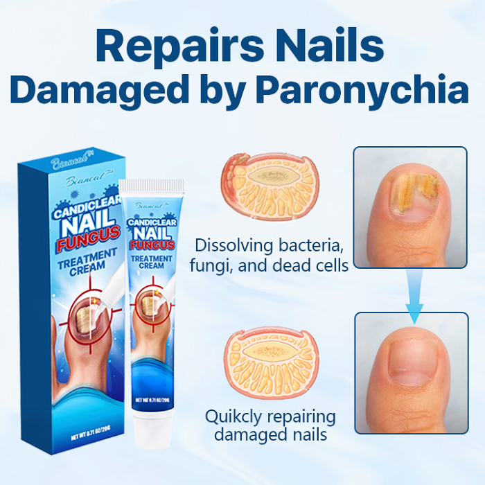 BiancatCandiclearNailFungusTreatmentCream