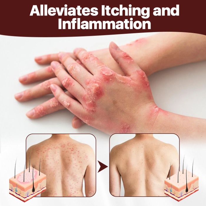 Biancat Cow's Fart Eczema Essence