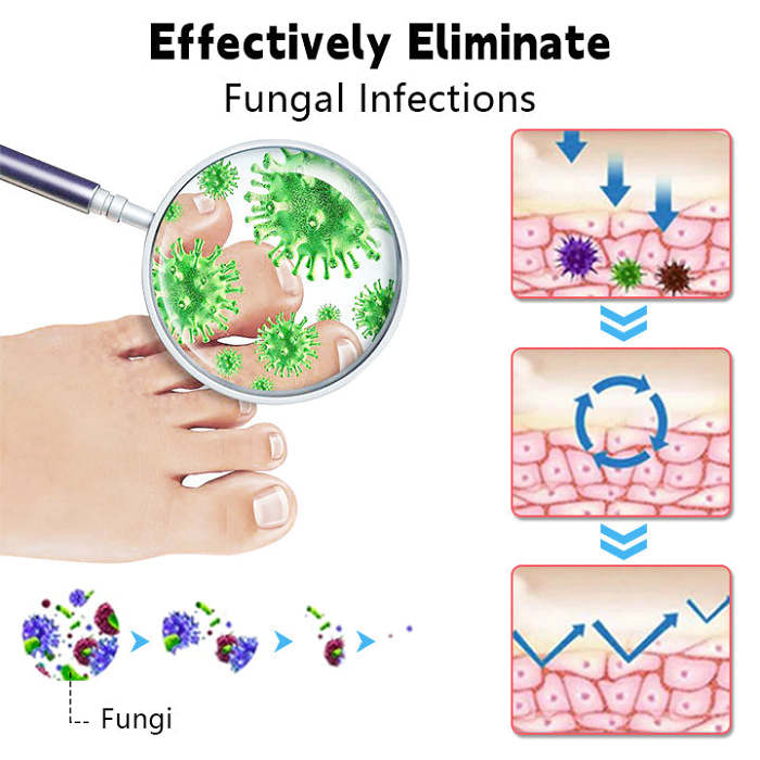 BiancatNailFungusLaserCleaningRepairDevice