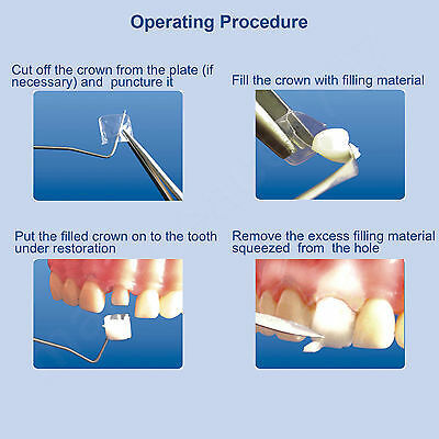 64pcs Dental Transparent Crown Anterior /Posterior/Deciduous Matrices Matrix for Adult TOR BM 1.910/1.911/1.912/1.915