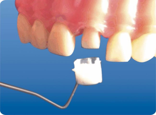 64pcs Dental Transparent Crown Anterior /Posterior/Deciduous Matrices Matrix for Adult TOR BM 1.910/1.911/1.912/1.915