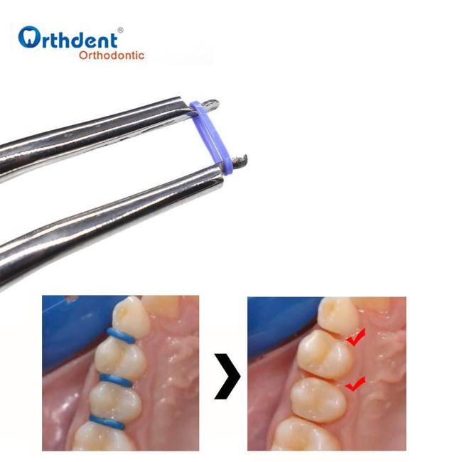 1000Pcs Dental Ligature Ties Separator Orthodontic Separate  Rubber Band Rings Bulk Pack