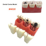 Orthdent 1Pcs Dental Caries Removable Teeth Model 4:1 Tooth Teaching Study Models M4020 Oral Evolvement Dentistry Lab Instrument