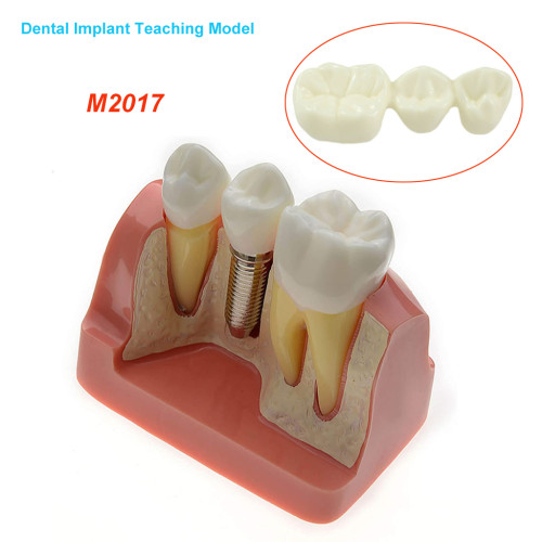 Orthdent 1Pcs Dental Implant Tooth Model Typodont Teeth Bridge M2017 Removable Implantion Crown Abutment Dentist Lab Instruments