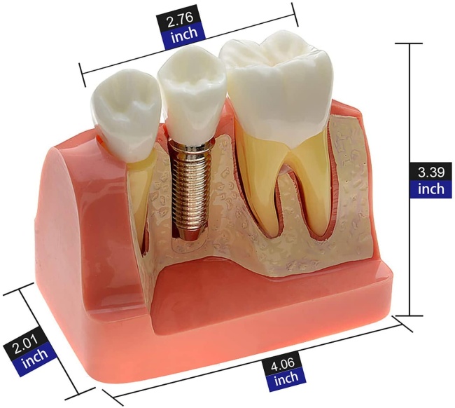 Orthdent 1Pcs Dental Implant Tooth Model Typodont Teeth Bridge M2017 Removable Implantion Crown Abutment Dentist Lab Instruments