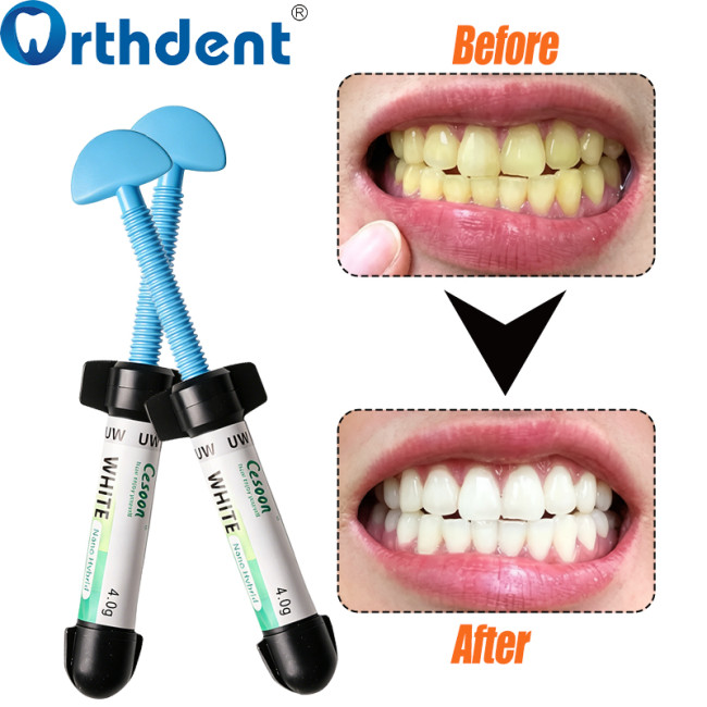 UW resin before and after teeth whitening comparison