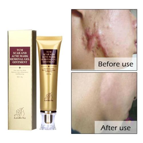 Scar and Acne Mark Removal Gel