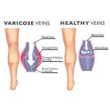 Varicose Veins Treatment Cream
