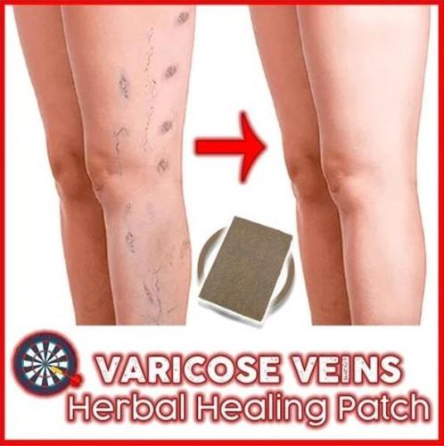 Varicose Veins Herbal Healing Patch