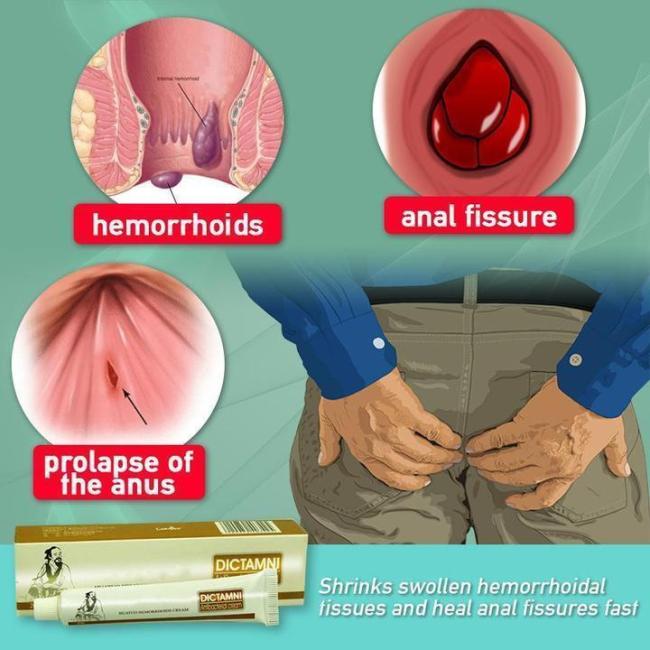 US 15.99 100 Natural Herbal Hemorrhoid Cream【BUY 3