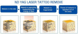Laser Tattoo Removal Machine (I)