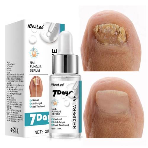 7DAYS Repair Nail Fungus Treatments Essence Foot Care Serum Toe Nails Fungal Removal Gel Anti-Infection