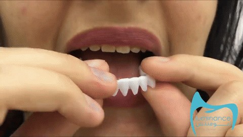 Magic Smile Teeth Brace