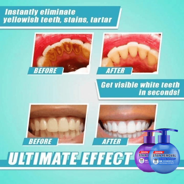 Last Day Promotion 48% OFF - Intensive Stain Removal Whitening Toothpaste