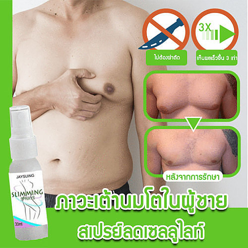 สเปรย์ลดเซลลูไลท์ภาวะเต้านมโตในผู้ชาย