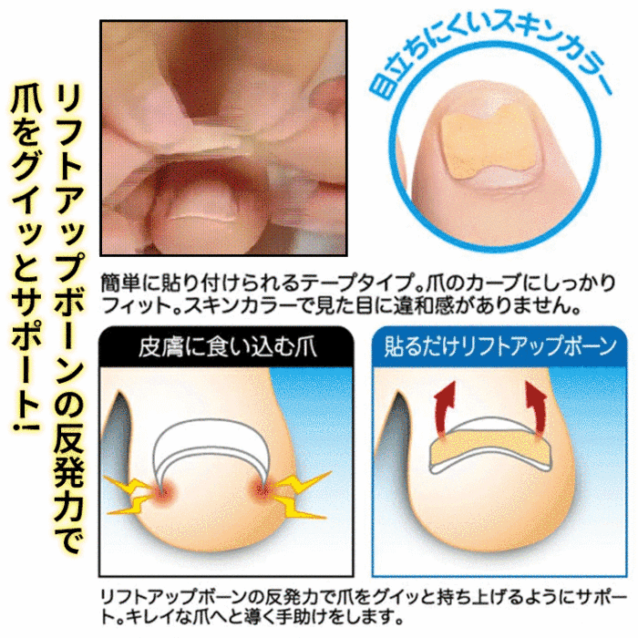 巻き爪矯正シール