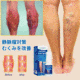 静脈瘤スプレー
