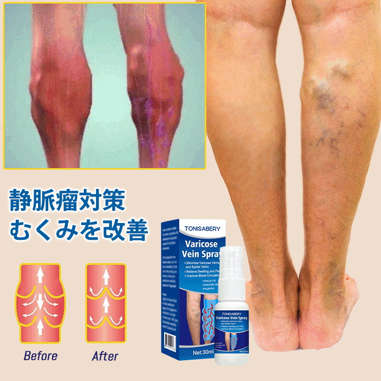 静脈瘤スプレー