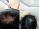 【日本名醫推薦】脫發嚴重！情緒總是會感到低落，羨慕頭發多的人？你也可以的！EELHOE密發頭發修復液，一周就能讓您見到毛孔長出了短短的頭髮啦！（1.5ml*10pcs/盒）