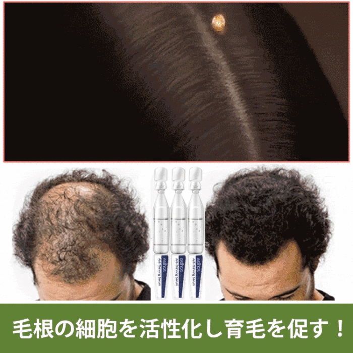【日本名醫推薦】脫發嚴重！情緒總是會感到低落，羨慕頭發多的人？你也可以的！EELHOE密發頭發修復液，一周就能讓您見到毛孔長出了短短的頭髮啦！（1.5ml*10pcs/盒）