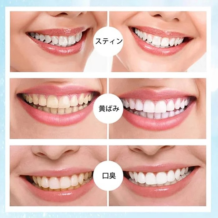 ホワイトニングペン