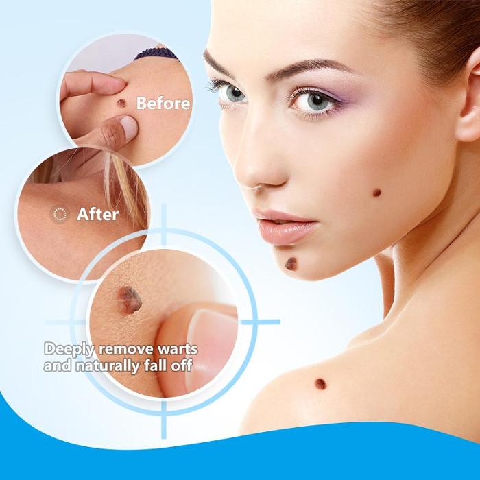 Anti-bacterial ointment for removing warts