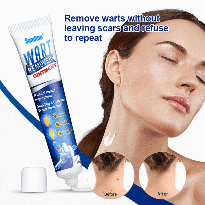 Anti-bacterial ointment for removing warts