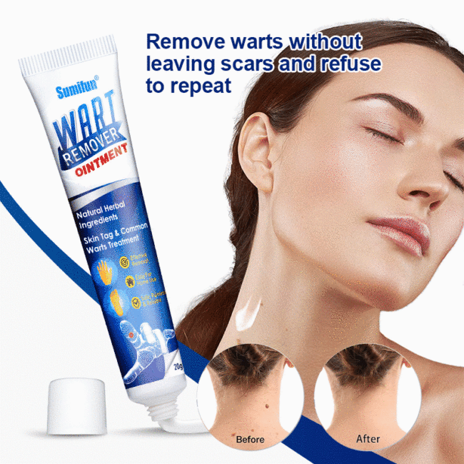 Anti-bacterial ointment for removing warts
