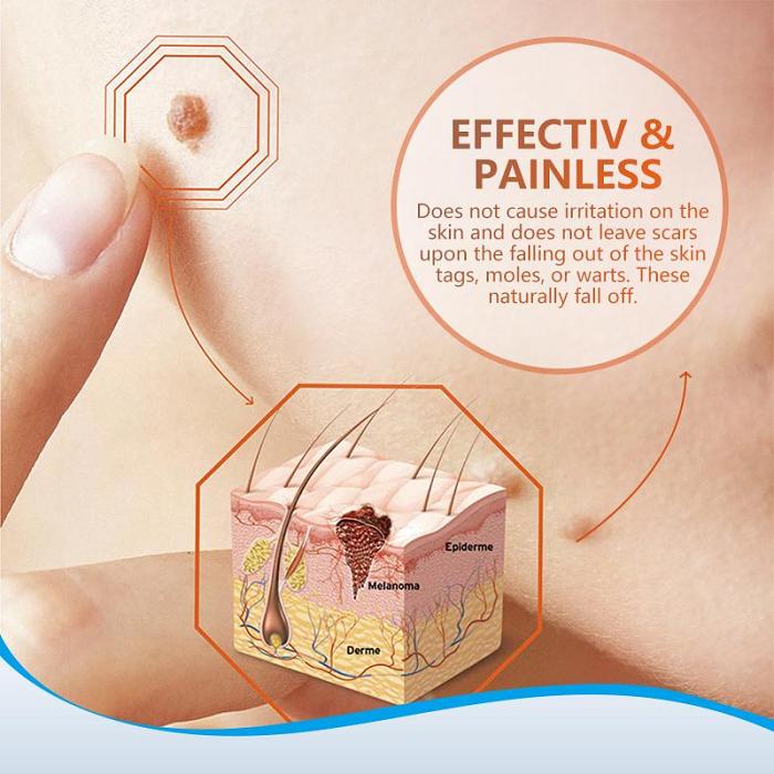 Anti-bacterial ointment for removing warts