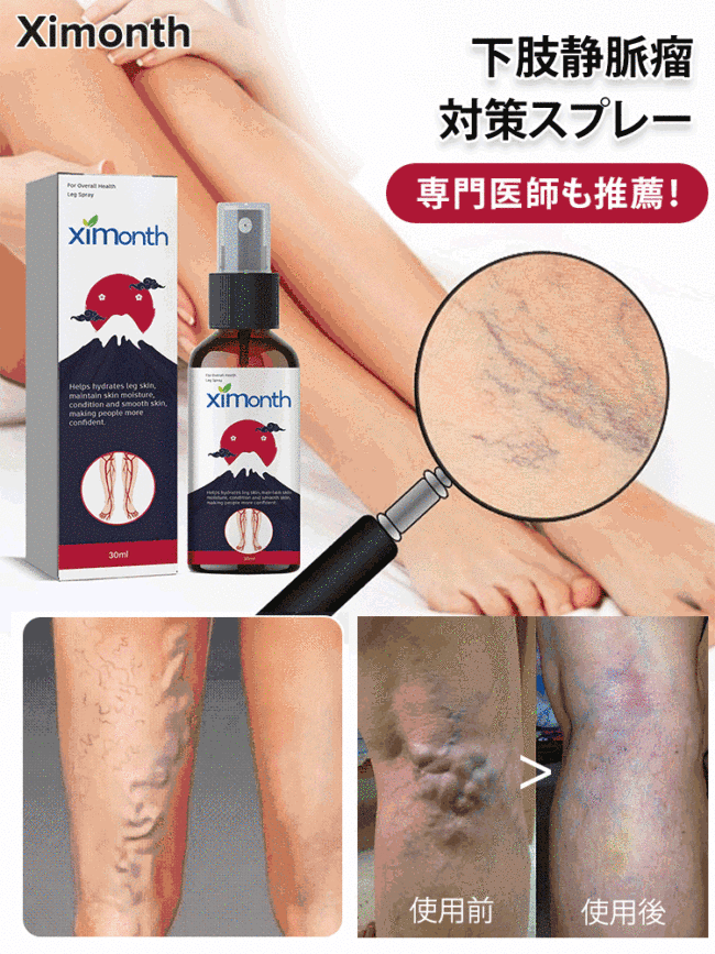 下肢静脈瘤対策スプレー