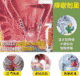 【三天「痔」好】痔立克冷敷凝膠，内痔，外痔一抹搞定，祛痔很輕鬆