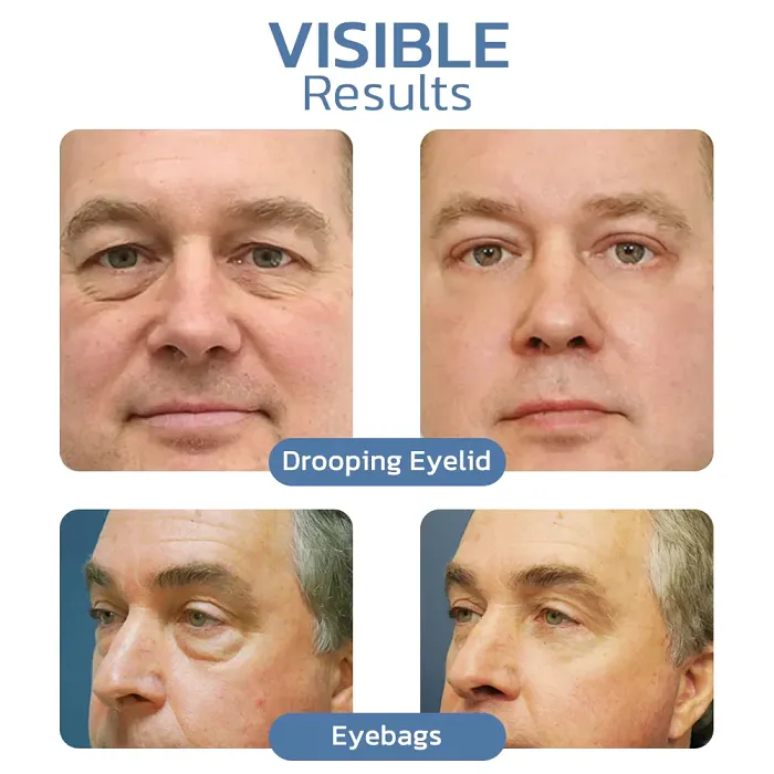 OPENEYES AWAKEN PEPTIDE LIFTING GEL FOR EYES