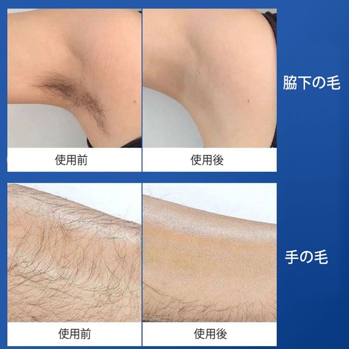 脱毛スプレー