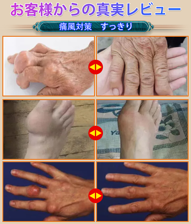 痛風軟膏