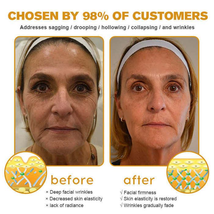 MHRA Approved✨Furzero™ Botox Bee Venom Wrinkle Removal Cream-Last Day Promotion 70% OFF