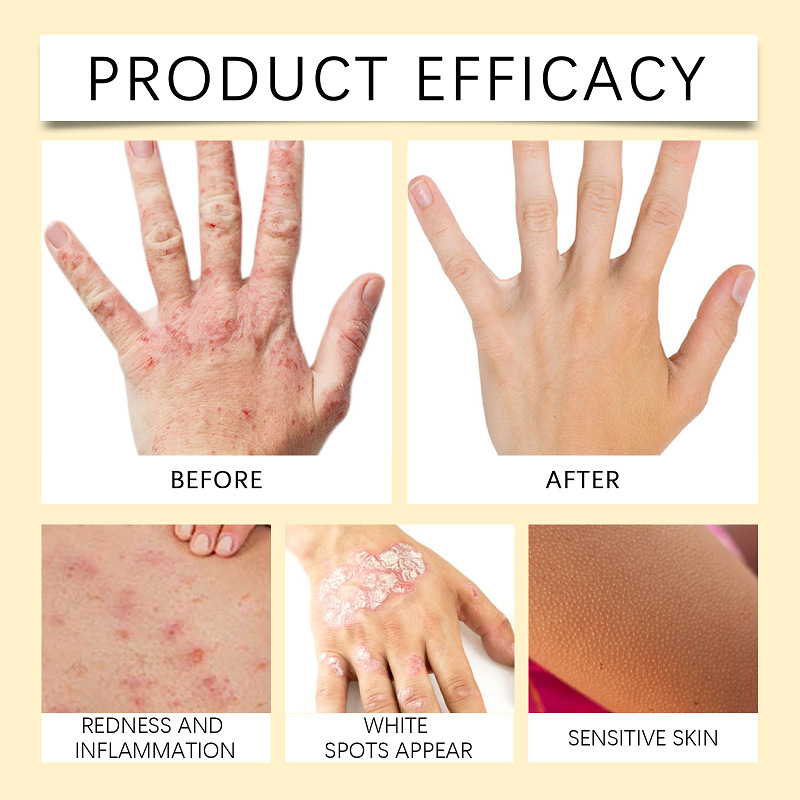 Ximonth™ BeeVenom Vitiligo Treatment Cream
