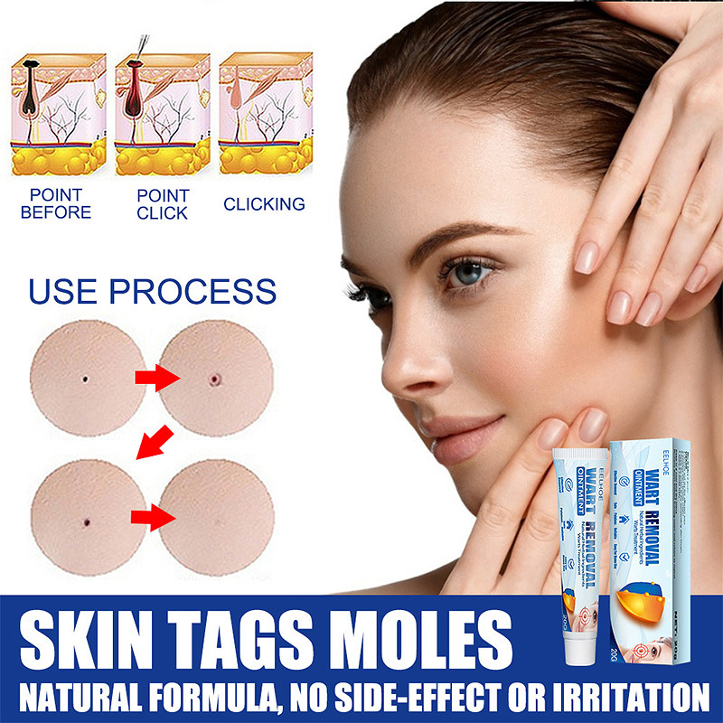 Wart Remover Gel