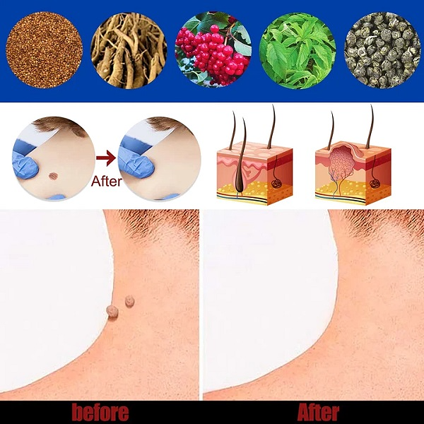 Wart Remover Gel