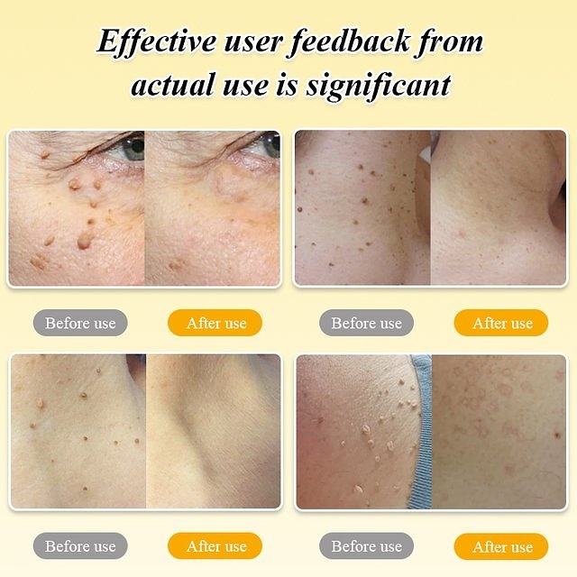 TagRecede Bee Venom Wart Treatment Spray