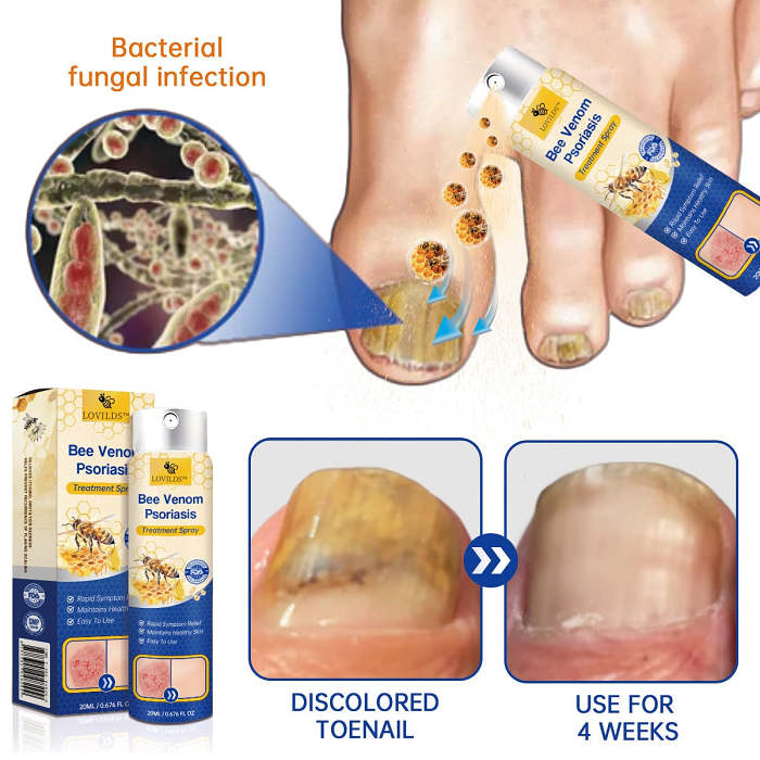 🔥50% off for a limited time 🐝LOVILDS™PsoriaHeal psoriasis Spray pro🔥