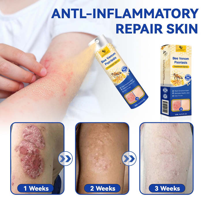 🔥50% off for a limited time 🐝LOVILDS™PsoriaHeal psoriasis Spray pro🔥