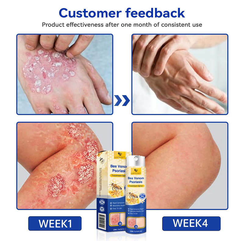 🔥50% off for a limited time 🐝LOVILDS™PsoriaHeal psoriasis Spray pro🔥